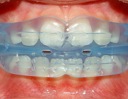 aparate-dentare-mobile-miofunctionale-cabinet-stomatologic-targu-mures